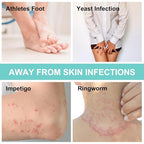 Antifungal Body Wipes, 30 Counts(6 Packs of 5) Travel Wipes, Non-Toxic Skin Camp Wipes Help Athletes Foot, Jock Itch, Ringworm. Rinse Free Gym Wipes for Wrestling, Martial Arts